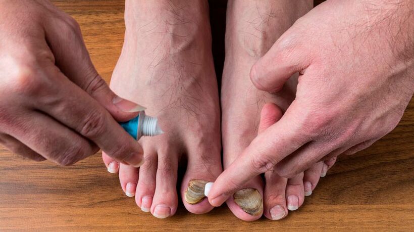 Apply antifungal cream on toenails to treat nail fungus