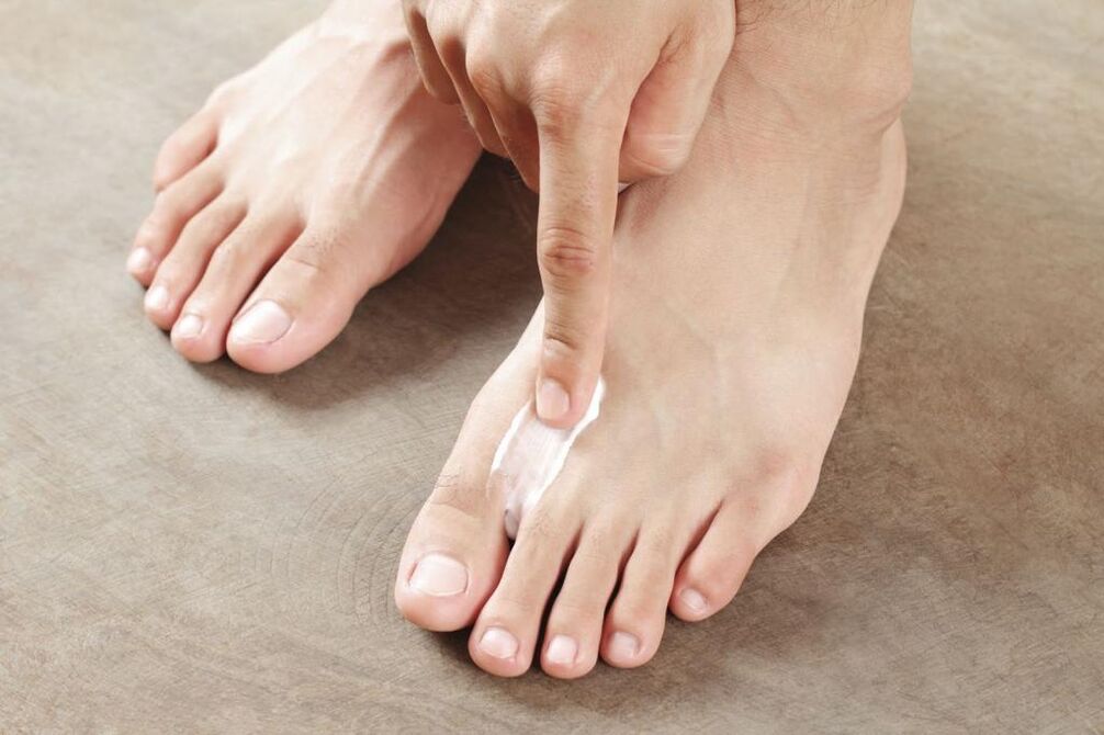 Application of a special ointment for the treatment of the interdigital form of the foot fungus