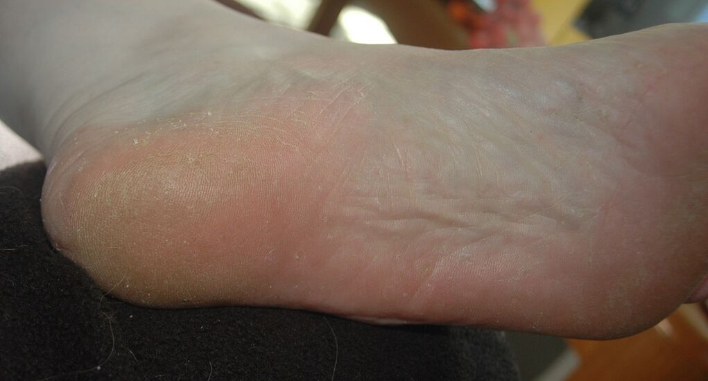 Squamous-hyperkeratotic form of the foot fungus