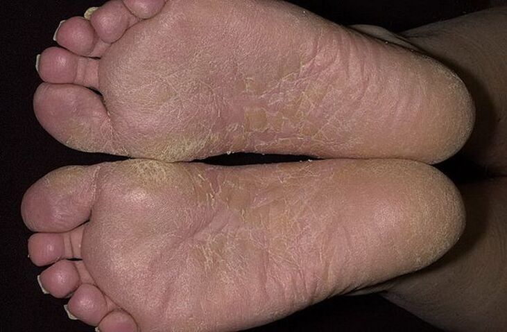 Dry, flaky skin on the feet is a sign of scaly mycosis