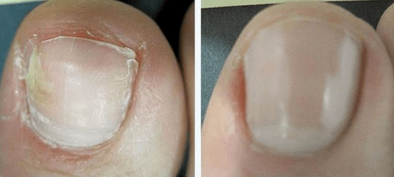 Toenail before and after fungus treatment