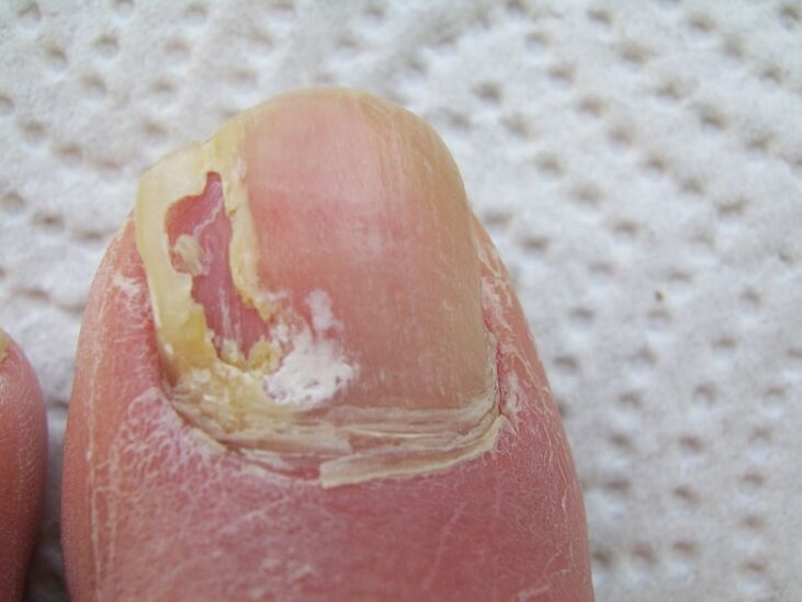 With onychomycosis, deformation of the nail plate occurs