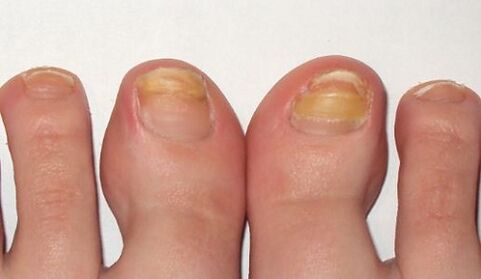 yellowing of the toenails with fungus