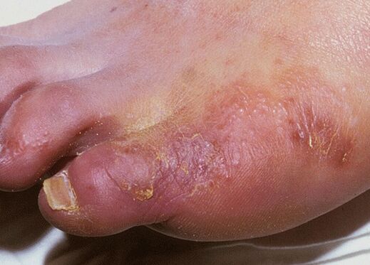 An example of a foot fungal infection caused by Trichophyton interdigitale