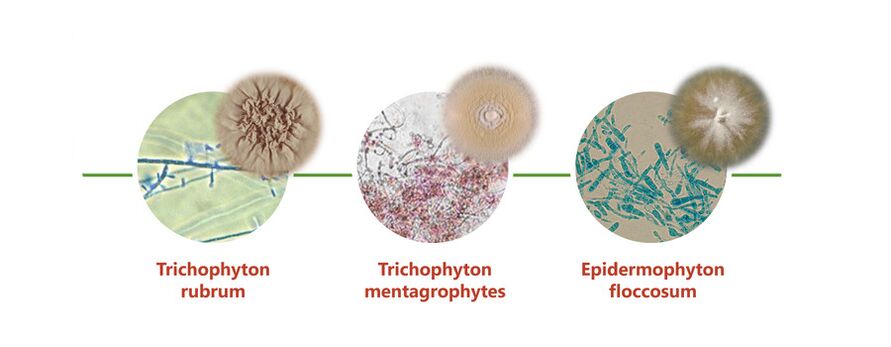 The main causative agents of the skin fungus on the legs