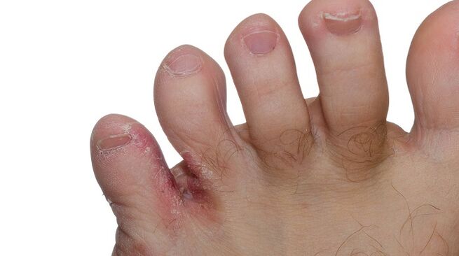 Signs of fungus between toes cracking and peeling skin