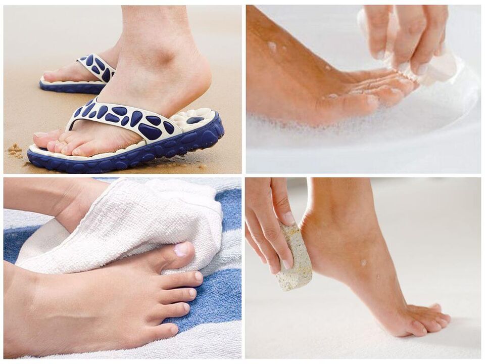 Prevention of onychomycosis includes foot hygiene, the use of personal items and timely pedicure